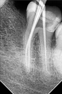 Endodonstski tretman u Sarajevu, liječenje korijena zuba
