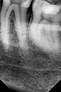 Endodonstski tretman u Sarajevu, liječenje korijena zuba