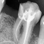 Endodonstski tretman u Sarajevu, liječenje korijena zuba