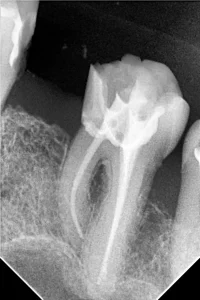 Endodonstski tretman u Sarajevu, liječenje korijena zuba