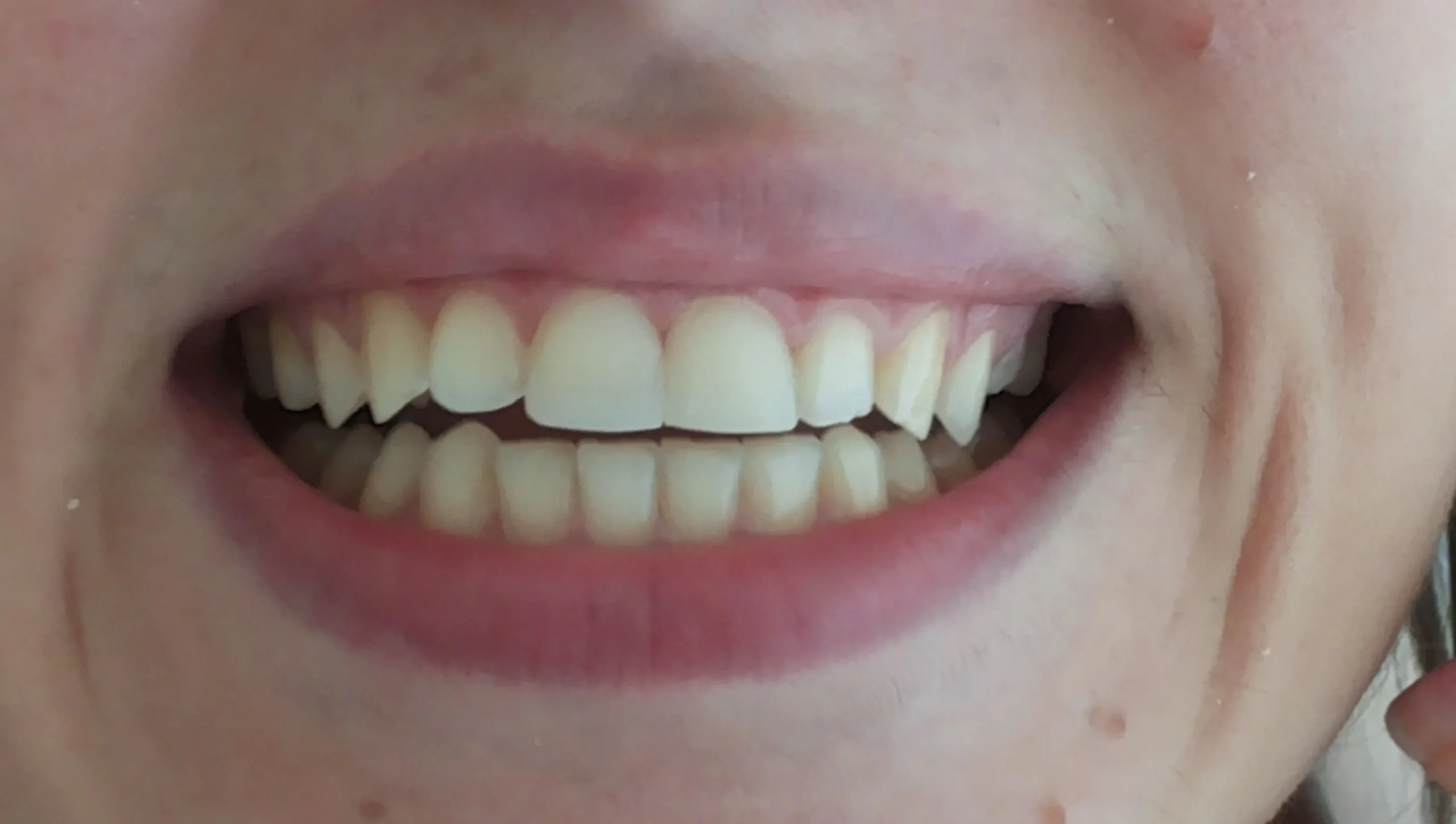 veneers sarajevo, fasete, ljuspice sarajevo, hollywood smile sarajevo