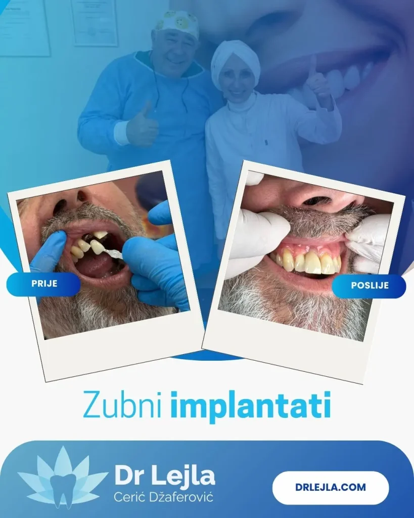 zubni implantati i prednosti u odnosu na klasična rješenja