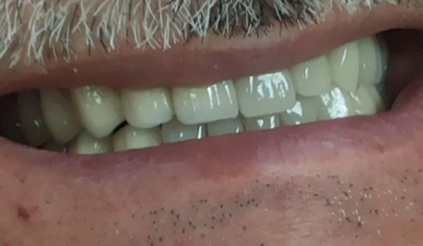 Metalkeramika_1a