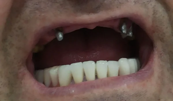 Metalkeramika_2