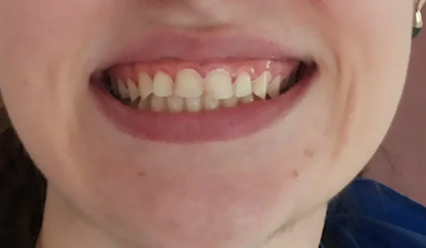 VENEERS_1