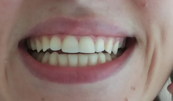 veneers sarajevo, fasete, ljuspice sarajevo, hollywood smile sarajevo