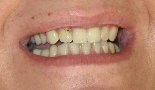 VENEERS_2