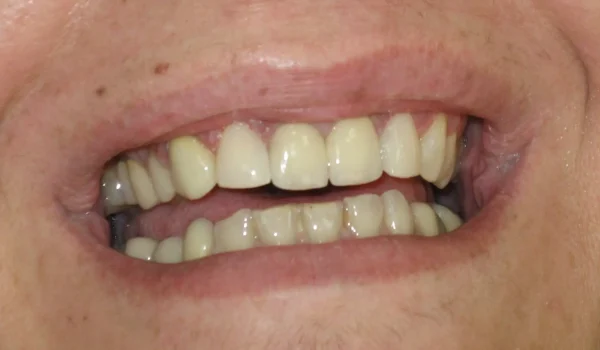 VENEERS_2a